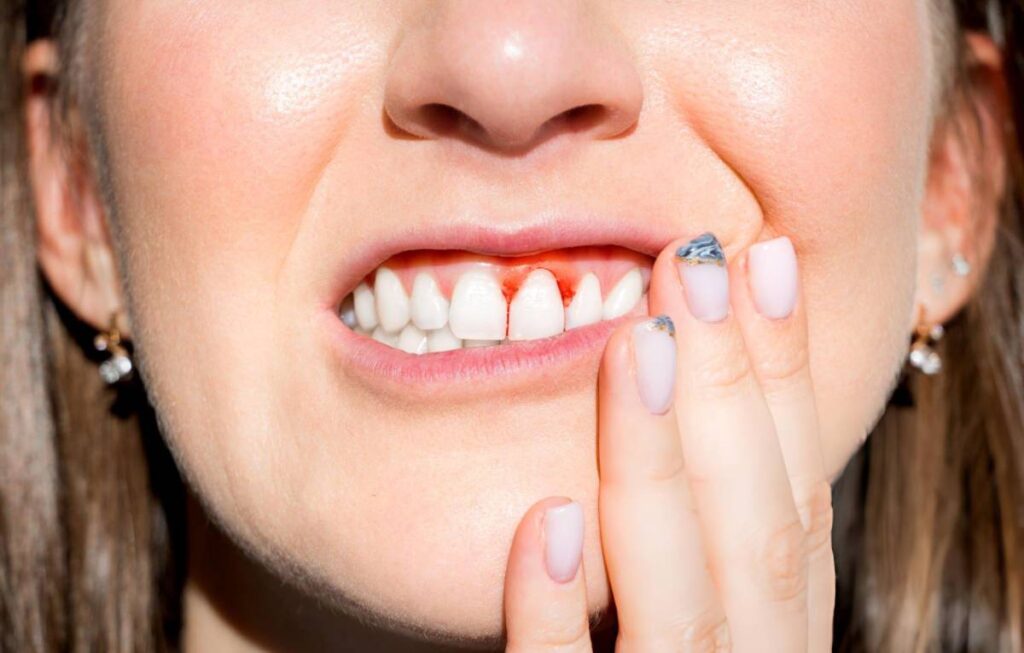 Bleeding Gums Causes