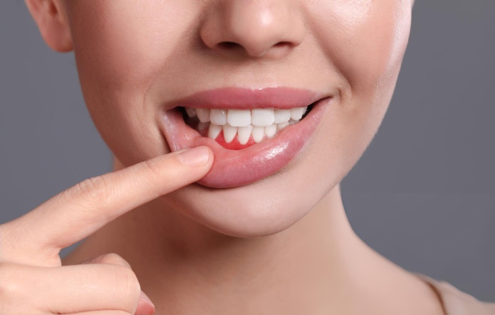 Hormonal Shifts: Life Stages and Gingival Sensitivity 