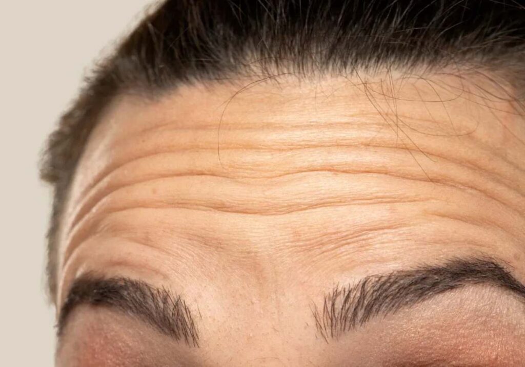 Wrinkles